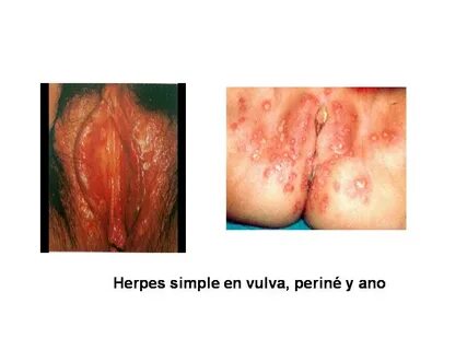 Herpes 1 y herpes 2