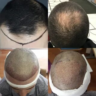 Все, что нужно знать о пересадке волос на голове