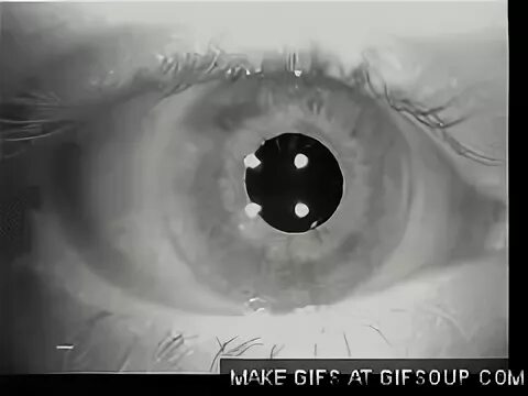 Nystagmus gif 8 " GIF Images Download