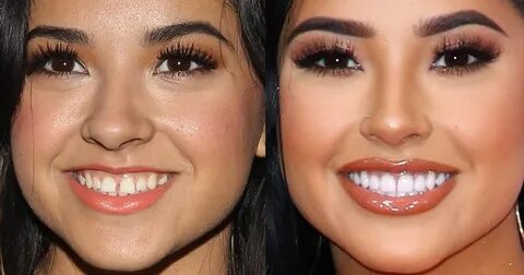 Becky G Teeth Evolution : Becky G teeth Gap and Whitening wi