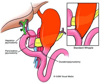Pancreatic Whipple Procedure Related Keywords & Suggestions 