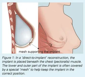 How Long Do Breast Implants Last After Mastectomy : Pin On L