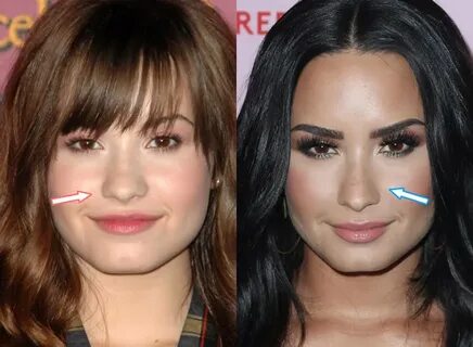 Did Demi Lovato Have Cosmetic Surgery? (Before & After 2022)