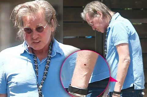 Val Kilmer Flesh Eating Cancer Scare