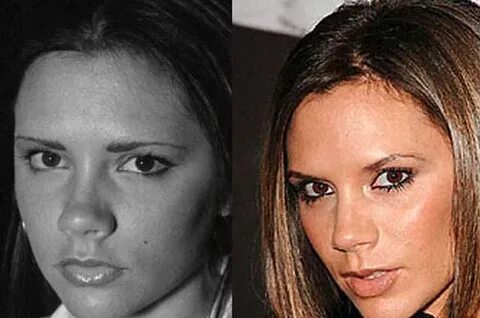 Victoria Beckham Nose Job Plastic Surgery Before and After C