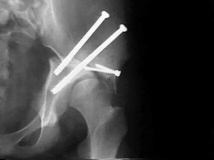 Ddh Hip Xray - maximalizad