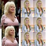 Dolly Parton Breast Implants Size Before & After - Brasizeme