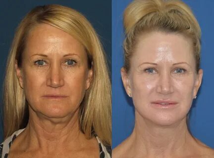 Facelift Before And After - change comin