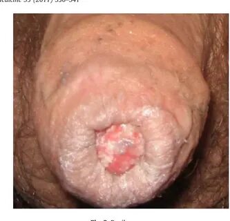 Hpv penis Genital Warts