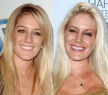 Heidi Montag Nose Job Plastic Surgery Before and After Celeb