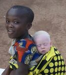 About Albinism Asante Mariamu