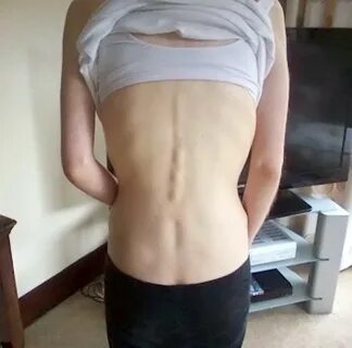 A young girl's anorexia became so severe she believed she co