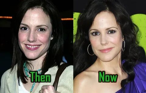 Mary Louise Parker: Plastic Surgery For Facelift, Nose Job, 