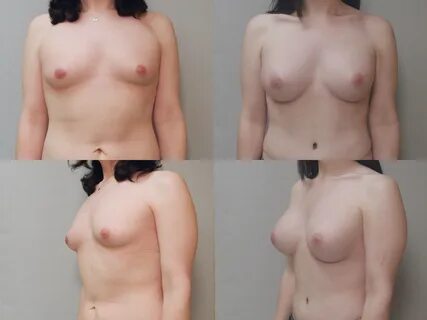 Hot picture Mtf Hrt Nude, find more porn picture before and after of breast...