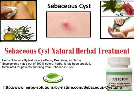 Sebaceous Cyst Natural and Herbal Treatment - Herbs Solution