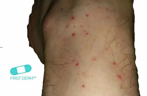Red spots on skin: Pictures, causes, treatment - Online Derm