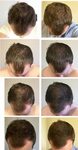 How To Stop Hair Loss Without Finasteride Reddit for Thick H