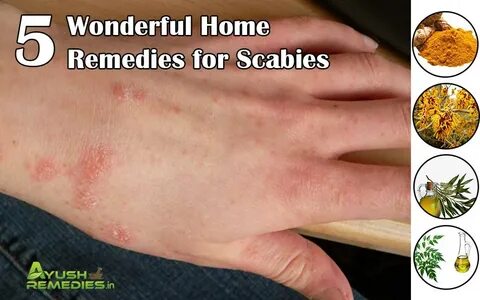 5 Home Remedies for Scabies, Treatment to Get Rid of Scabies