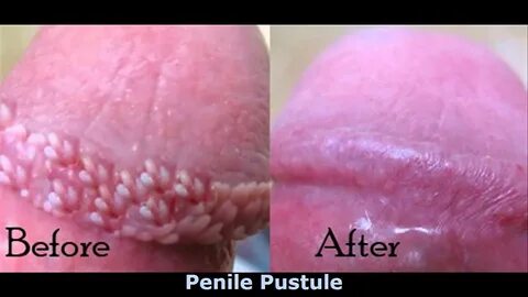 Pearly Penile Papules Home Treatments - YouTube