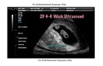 6-8 Week Ultrasound - All pregnant women in england are offe