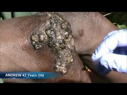 Popping Millions of Jiggers (Treatment) - YouTube