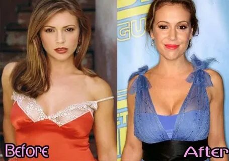 Alyssa Milano Breast Implants