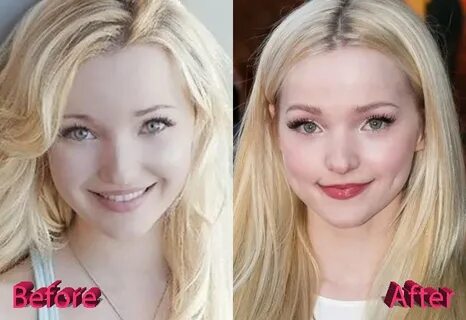Dove-Cameron-Before-and-After-Nose-Job-Surgery - Celebrity P