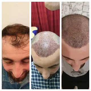 До и после пересадки волос пациент Б.