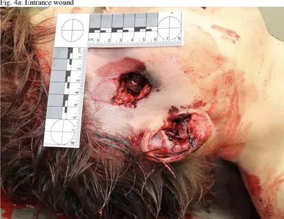 Figure 4 from An unusual exit wound as a result of a shotgun