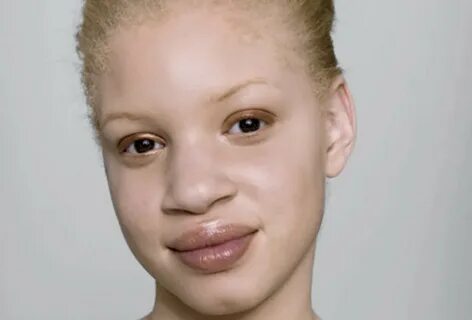 Albino black people