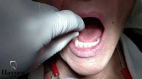 Hayven Dentures Suction Dentures in St Catharines Niagara On