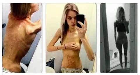 This Young Lady Is Battling Anorexia And This Is Her Powerfu