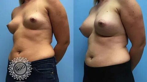 Breast Augmentation Right For Older Woman?