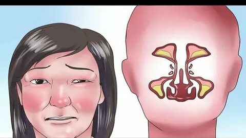 3 Simple Remedies to Get Rid of a Really Stuffy Nose - YouTu