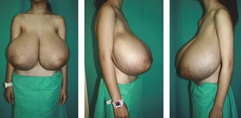 Reducing boob size tits