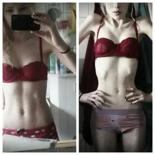 Extreme Thinspo Real Girls: Thinspo: Before and After