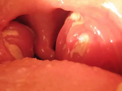 File:Mono tonsils.JPG - Wikipedia