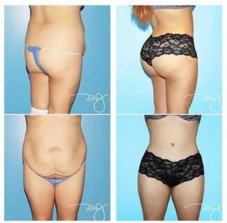 Liposuction And Bbl Before And After - Diet Plan