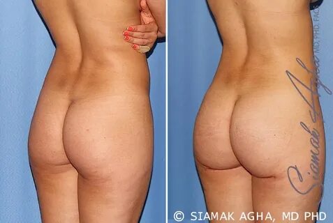 Brazilian Butt Lift Newport Beach - Before & After Patient #