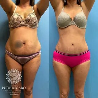 35 F After Tummy Tuck with Lipo 360 Petrungaro Plastic Surge