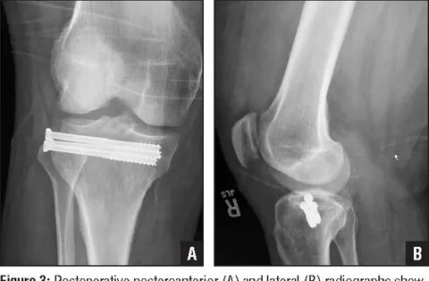 Figure 3 from Preliminary Result of Percutaneous Screw Fixat