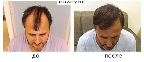 Hair transplant K. Mihaly 4500 before after