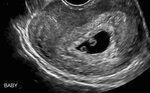5 Weeks Pregnant Ultrasound - #5-weeks-pregnant on Tumblr : 