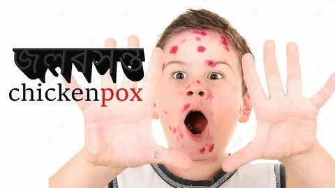 জলবসন্ত বা chickenpox - YouTube