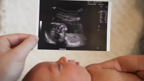 Picture Perfect Design Idea For Ultrasound Pictures - Live P