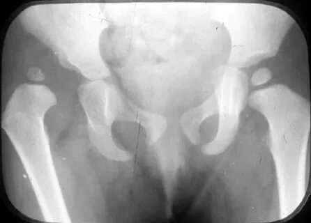 Developmental Dysplasia of the Hip (DDH) - Pediatrics - Orth