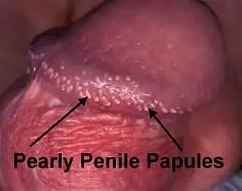 Dots around penis head Penile Bumps Causes on Shaft, Scrotum