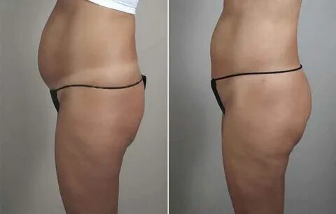 Lipo before and after stomach 13 Lipo before and after, Lipo