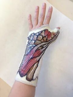 One of my friends had surgery on his hand and hand painted a