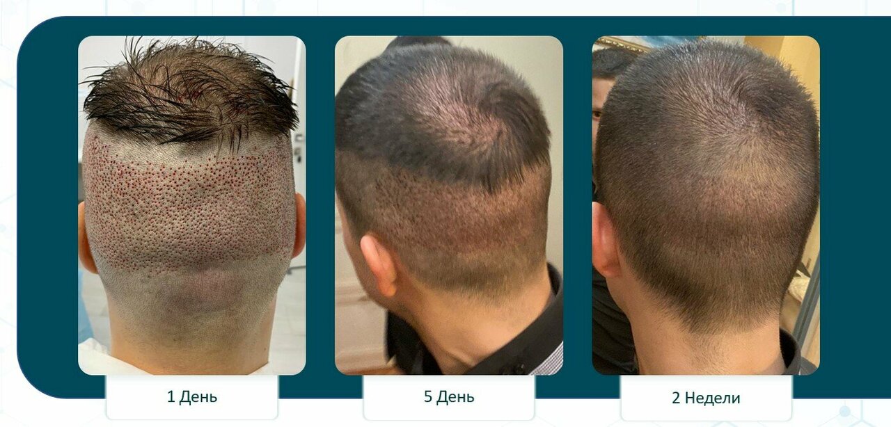 Пересадка волос в Химках: методы и цены 2026